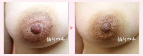 乳輪縮小失敗 他院修正症例写真2