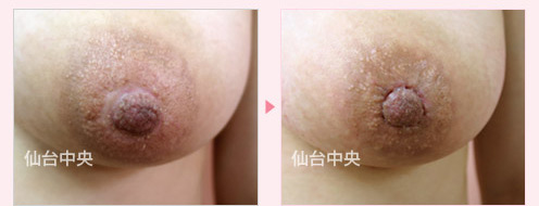 乳輪縮小失敗 他院修正症例写真3