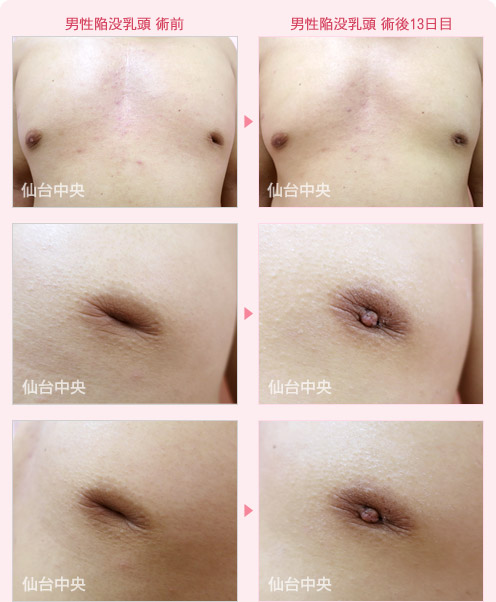 男性陥没乳頭