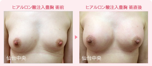 ヒアルロン酸注入豊胸 症例写真1
