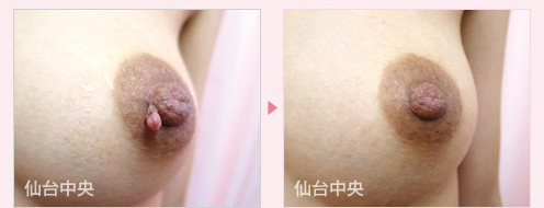 乳頭腫瘍除去 症例写真3