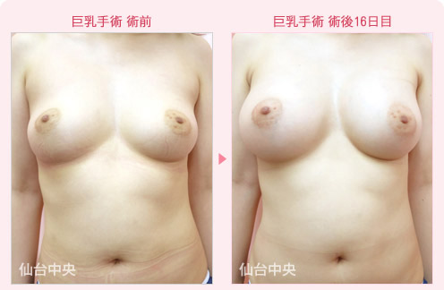 巨乳手術 症例写真1