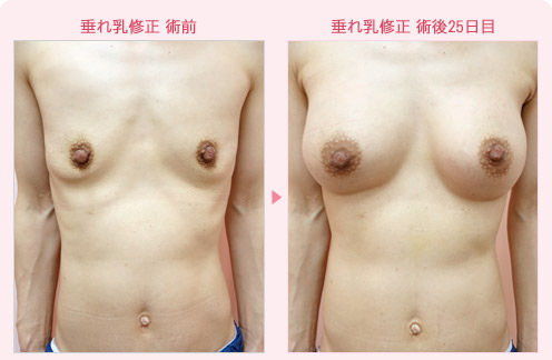 垂れ乳修正 症例写真1