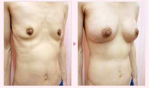 垂れ乳修正 症例写真2