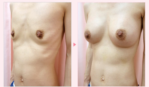 垂れ乳修正 症例写真3