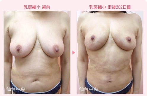 乳房縮小 症例写真1