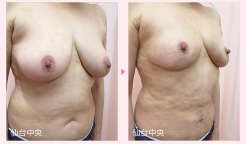 乳房縮小 症例写真2