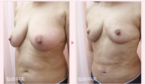 乳房縮小 症例写真3