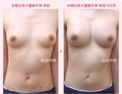 未婚女性の豊胸手術 症例写真1