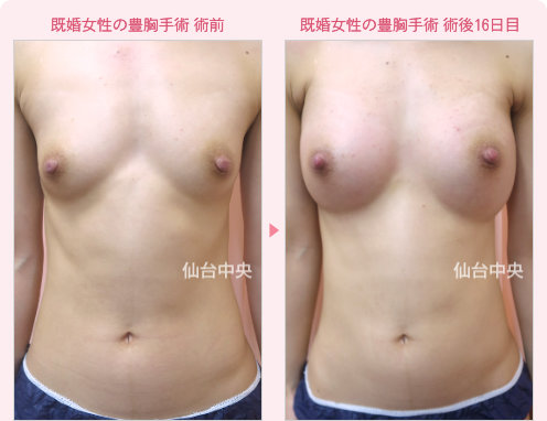 既婚の豊胸手術 症例写真1