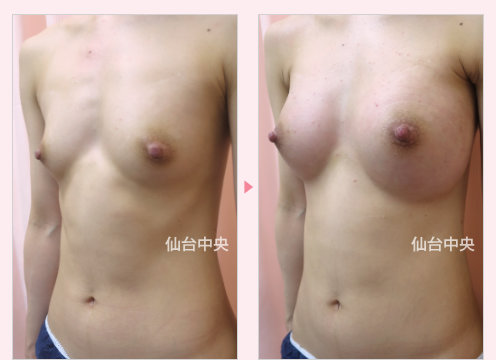 既婚の豊胸手術 症例写真3