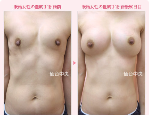 既婚の豊胸手術 症例写真1