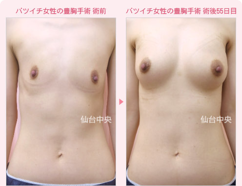 バツイチ女性の豊胸手術 症例写真1