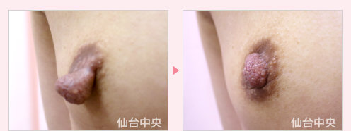 乳頭縮小 症例写真2