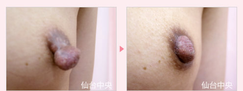 乳頭縮小 症例写真3