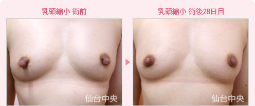 乳頭縮小 症例写真1