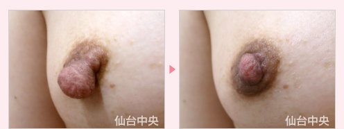 乳頭縮小 症例写真2