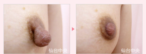 乳頭縮小 症例写真3