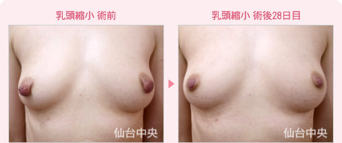 乳頭縮小 症例写真1