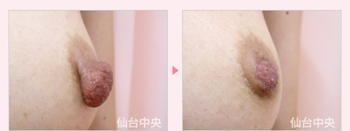 乳頭縮小 症例写真3