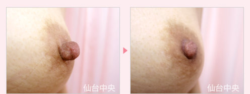 乳頭縮小 症例写真3