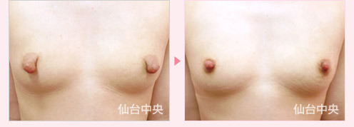 乳頭縮小 症例写真1