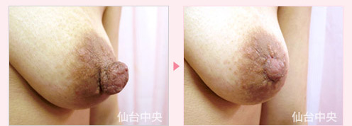 乳頭縮小 症例写真3