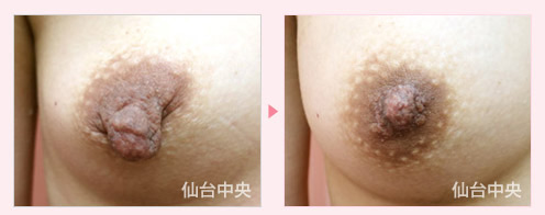 豊胸乳頭同時手術 症例写真4