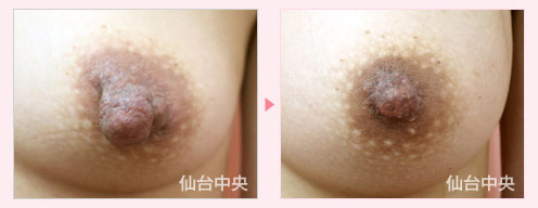 豊胸乳頭同時手術 症例写真5