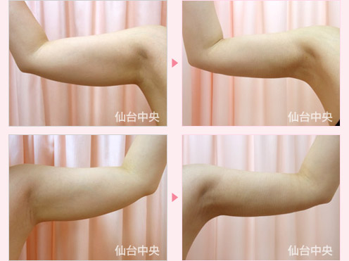 顎脂肪吸引