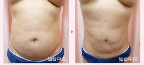 腹部脂肪吸引 症例写真1
