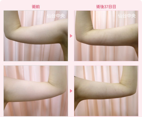 二の腕脂肪吸引 症例写真