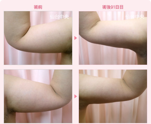 二の腕脂肪吸引 症例写真