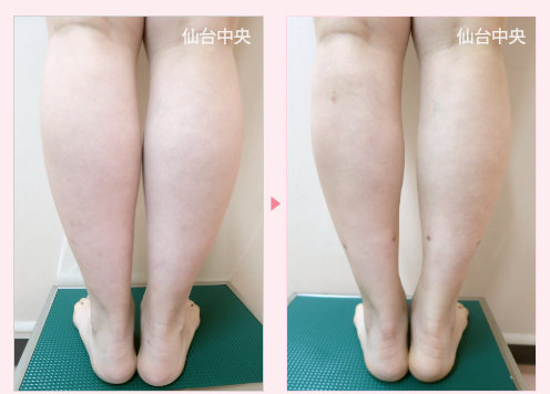 ふくらはぎ足首脂肪吸引 症例写真