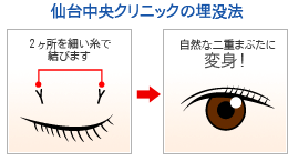 仙台中央クリニックの埋没法