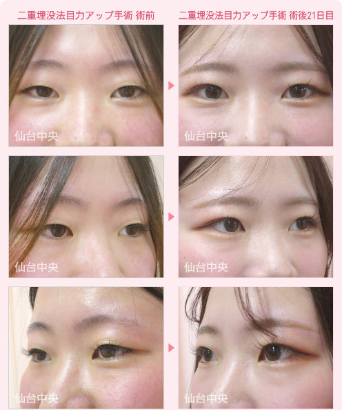 二重埋没法目力アップ手術 症例写真