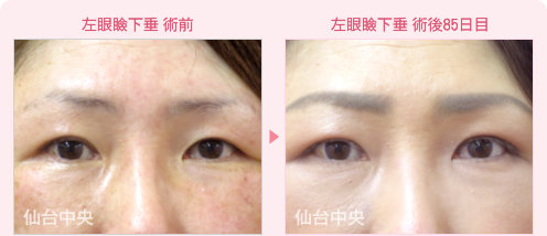 左眼瞼下垂修正手術 症例写真 - 術前と術後85日目の比較、正面