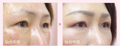 左眼瞼下垂修正手術 症例写真 - 術前と術後85日目の比較、右向き