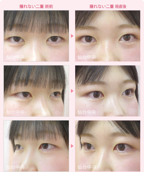 腫れない二重 症例写真