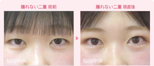 腫れない二重 症例写真 - 術前と術直後の比較、正面