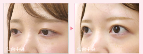 二重幅変更パッチリ目手術症例写真 - 術前と術後14日目の比較、左向き