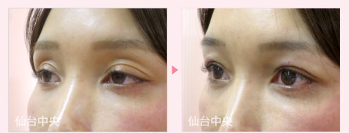 窪み目修正 症例写真 - 術前と術直後の比較、左向き