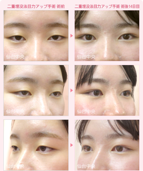 二重埋没法目力アップ手術 症例写真