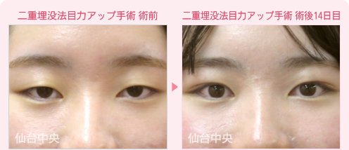 二重埋没法目力アップ手術 症例写真 - 術前と術後14日目の比較、正面