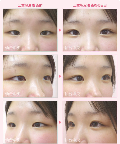 二重埋没法 症例写真