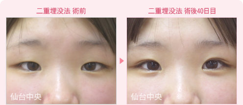 二重埋没法 症例写真 - 術前と術後40日目の比較、正面