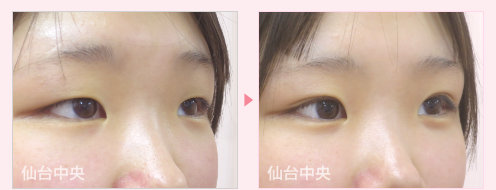 二重埋没法 症例写真 - 術前と術後40日目の比較、右向き