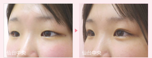 二重埋没法 症例写真 - 術前と術後40日目の比較、左向き