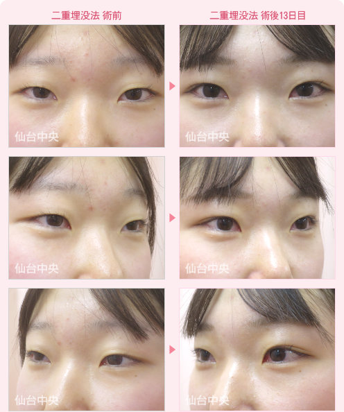 二重埋没法 症例写真