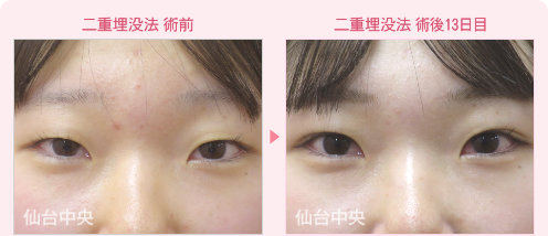 二重埋没法 症例写真 - 術前と術後13日目の比較、正面